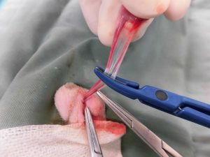 血管シーリングシステム導入