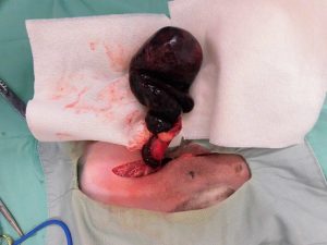 精巣腫瘍+精巣捻転