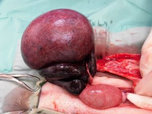 子宮捻転の手術