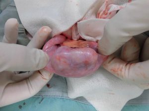 子宮腫瘍の摘出手術