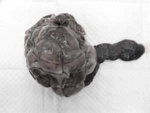 脾臓の巨大腫瘍（線維組織球性結節）