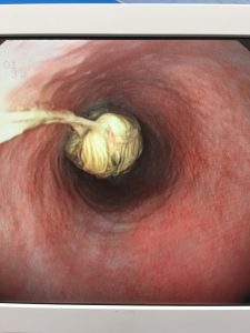 口腔内および食道内～十二指腸の異物除去