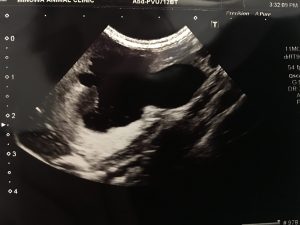 尿管結石の摘出手術