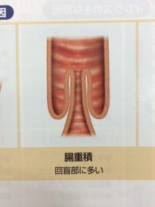 腸重積の手術