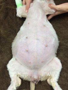 巨大な子宮腫瘤摘出